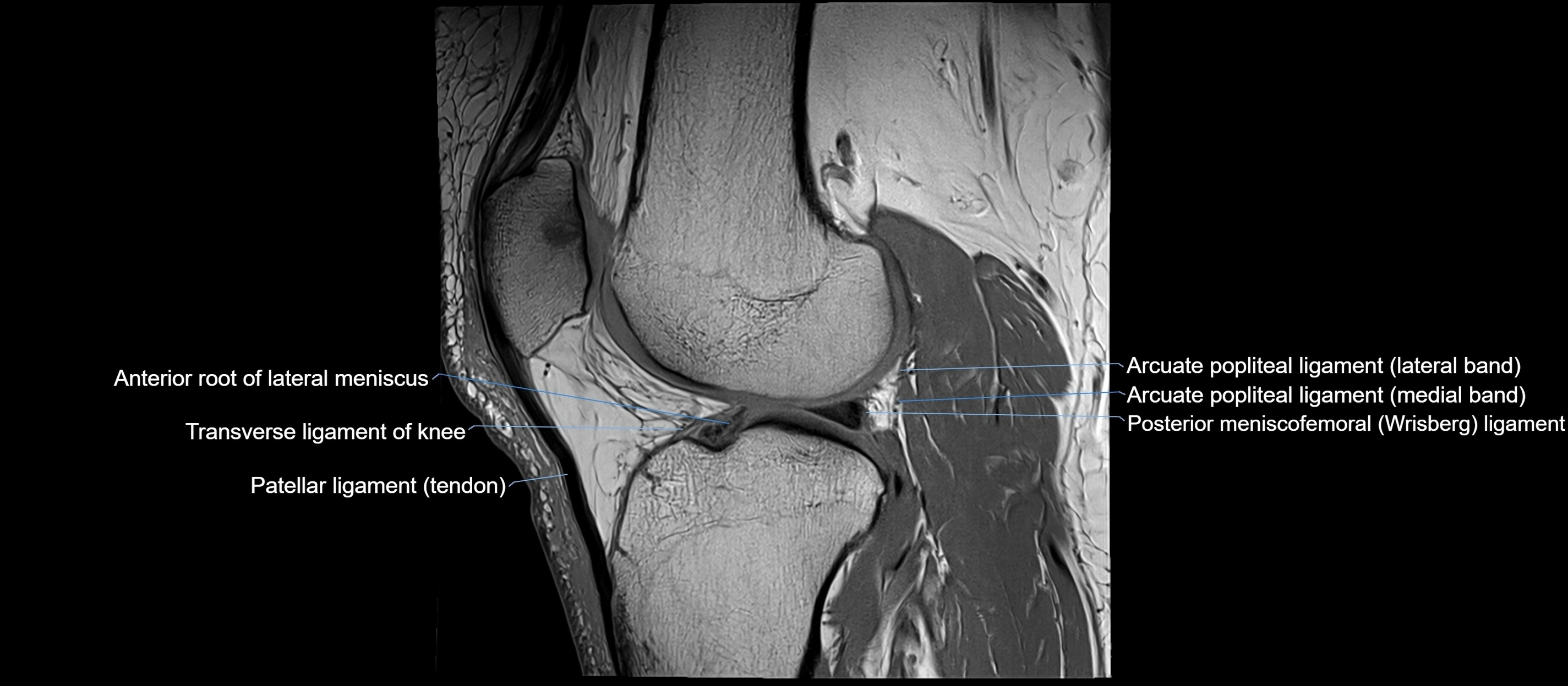 MRI sagittal  ligaments cross sectional anatomy 3T  radiology  image-img-00001-00030.webp